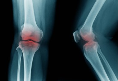 yaşlı adamın yüksek kaliteli x-ray diz eklemi, mavi tonda siyah arka plan yaşlı adamın Oa diz