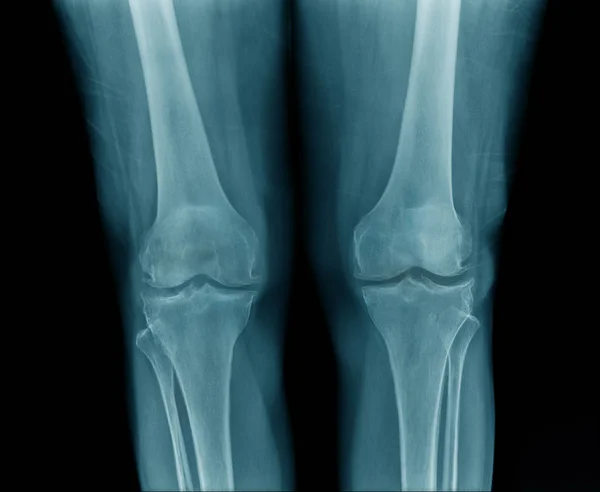 青い色調の黒い背景に老人の高品質X線膝関節 老人のオア膝 — ストック写真