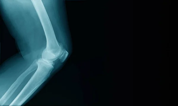 具有横幅设计的X光图像膝关节 用于网页和高质量打印 — 图库照片