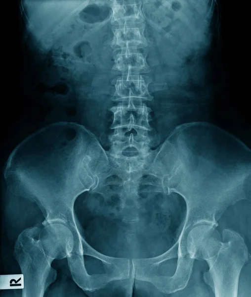 Röntgenbild Eines Alten Mannes Röntgenbild Der Lendenwirbelsäule Mit Beckenknochen Blauem — Stockfoto