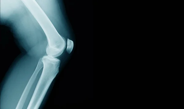 Ray Image Knee Joint Banner Design Webpage Hight Quality Print — Stock Photo, Image