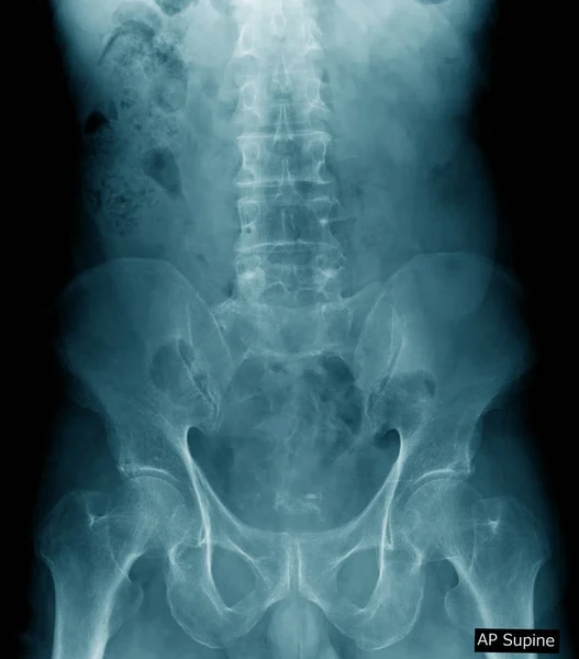 Vieil Homme Radiographie Radiographie Lombaire Avec Pelvien Dans Ton Bleu — Photo