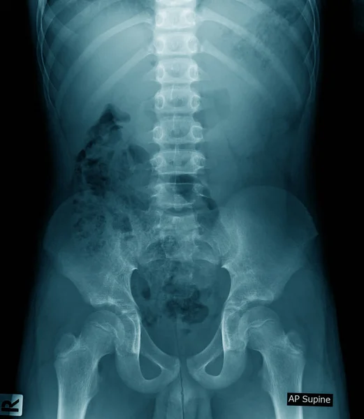 Рентген Старика Поясничное Рентгеновское Изображение Синим Тоном Тазовой Кости — стоковое фото