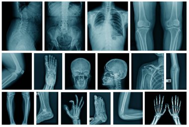 mavi tonda toplama x-ray görüntü 