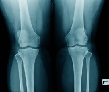 yaşlı adamın yüksek kaliteli x-ray diz eklemi, mavi tonda siyah arka plan yaşlı adamın Oa diz 