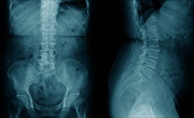 x-ray human spine AP and lateral view in blue tone 