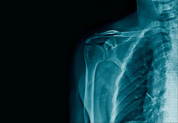 Ray Image Clavicle Fracture Blue Tone — Stok fotoğraf