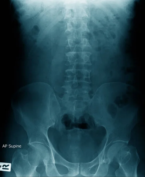 x-ray image of human spine and pelvic bone