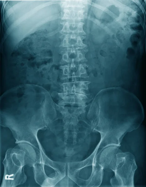 Ray Image Human Spine Pelvic Bone — Stock Photo, Image