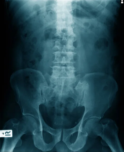 Ray Image Human Spine Pelvic Bone — Stok fotoğraf