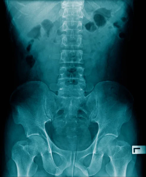 Рентгеновское Изображение Позвоночника Тазовой Кости — стоковое фото