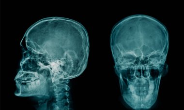 insan kafatası x-ray görüntüsü 