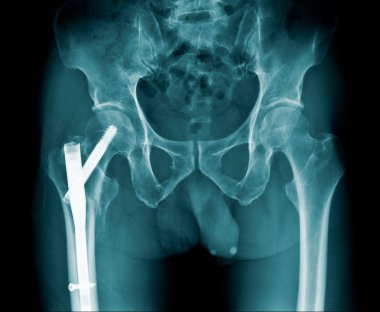 x-ray görüntü kalça kırığı veya intertrochanteric kırık ve sonrası 