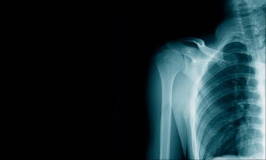 x-ray görüntü köprücük kırığı