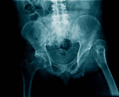 X-ray görüntü leğen kemiği ve kalça eklemi
