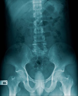 İnsan omurgasının x-ray görüntüsü
