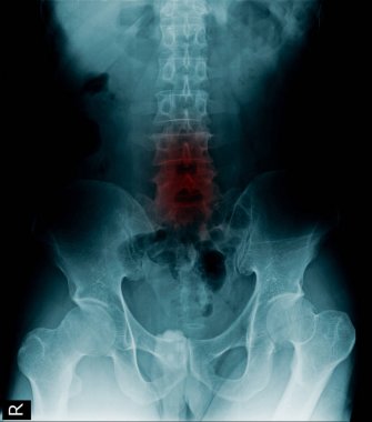 İnsan omurgasının x-ray görüntüsü