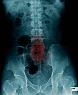 x-ray image of human spine clipart