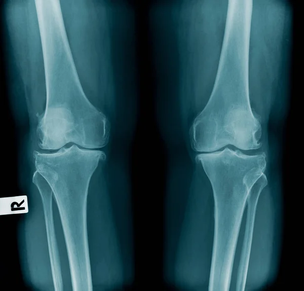 Рентгенівське зображення ОА коліно — стокове фото
