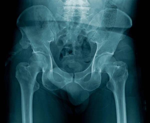 x-ray image pelvic bone and hip joint