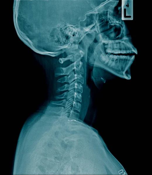 Cervical spine spondylosis — Stock Photo, Image
