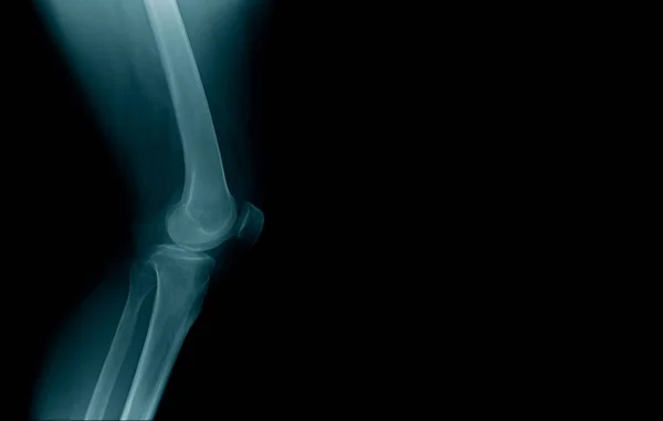 Obraz rentgenowski stawu kolanowego — Zdjęcie stockowe