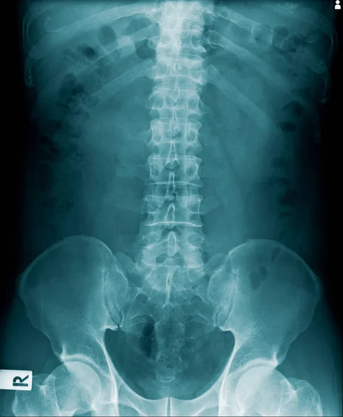 İnsan omurgasının x-ray görüntüsü — Stok fotoğraf