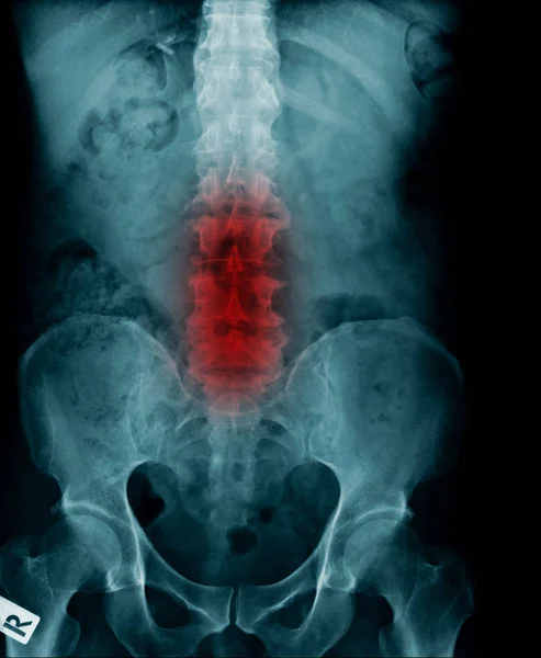 X-ray image of human spine — Stock Photo, Image