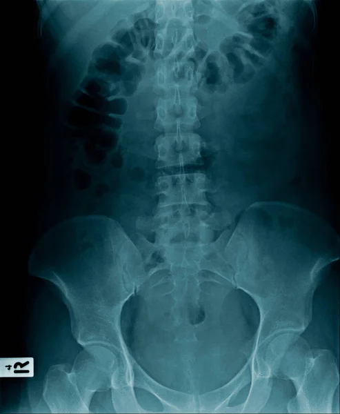 Рентгенівське зображення хребта людини — стокове фото
