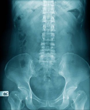 x-Ray görüntü lomber omurga ve omurga dejeneratif değişim, mavi tonl l-spondylosis x-Ray görüntü