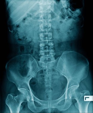 x-Ray görüntü lomber omurga ve omurga dejeneratif değişim, mavi tonl l-spondylosis x-Ray görüntü