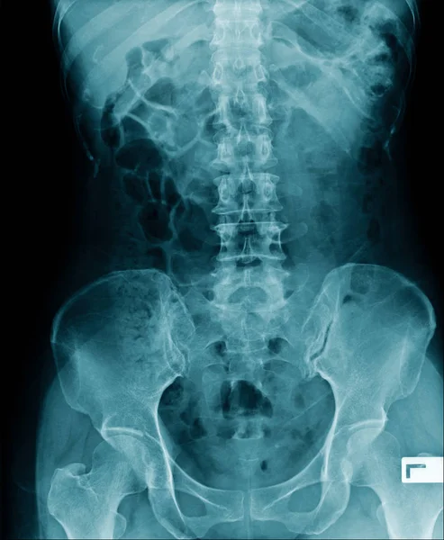 Röntgenbild Lendenwirbelsäule Und Degenerative Veränderung Der Wirbelsäule Spondylose Röntgenbild Blauton — Stockfoto