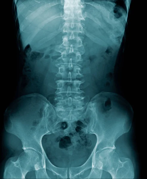 x-ray image lumbar spine and degenerative change of spine, l-spondylosis x-ray image in blue tone
