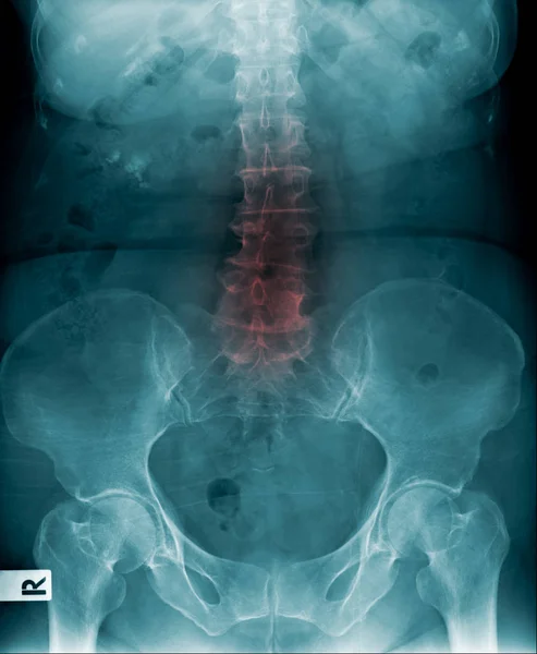 Imagem Raios Coluna Lombar Alteração Degenerativa Coluna Vertebral Espondilose Imagem — Fotografia de Stock