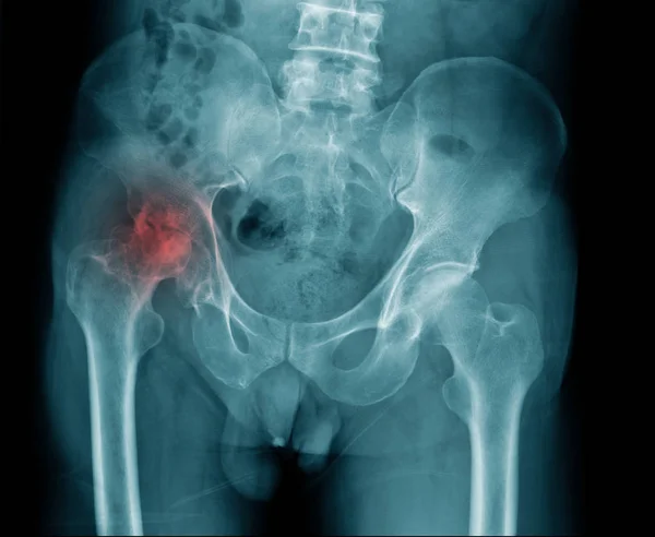 x-ray image of pelvic bone and show avascular necrosis at hip, hip osteoarthritis in blue tone