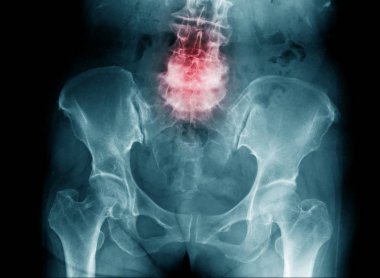 spondilosis x-Ray görüntüsü, insan omurgasının sıkıştırma kırığı L4-5 x-Ray görüntüsü