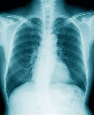 hight qaulity göğüs x-ray görüntü