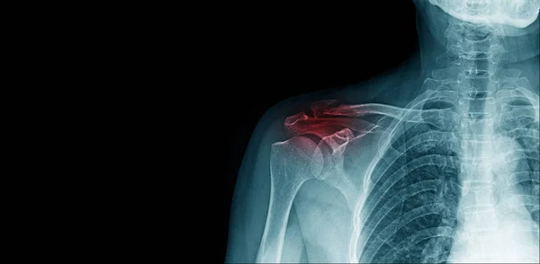 Ray Image Shoulder Pain Clavicle Fracture Copy Space — Stock Photo, Image