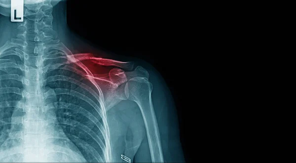 Image Radiographique Douleurs Épaule Avec Fracture Clavicule Espace Copie — Photo