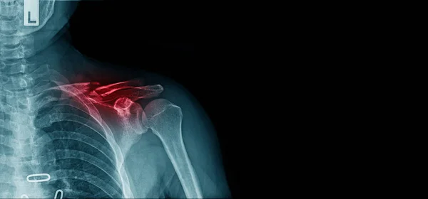 Ray Image Shoulder Pain Clavicle Fracture Copy Space — Stock Photo, Image