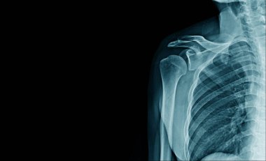 Omuz eklemi ve köprücük kemiğinin x-ray görüntüsü