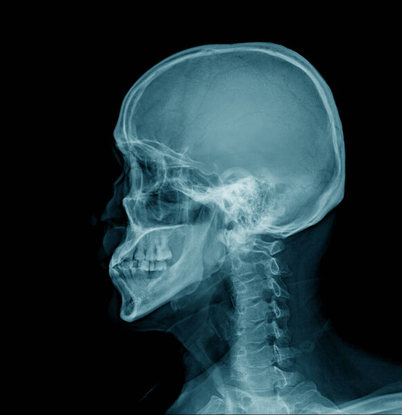 human skull x-ray image and cervical spine in lateral view