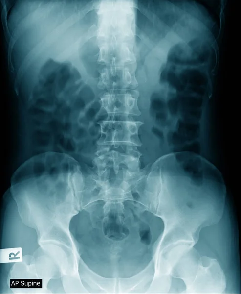 Röntgenfoto Van Menselijke Wervelkolom Blauwe Toon — Stockfoto