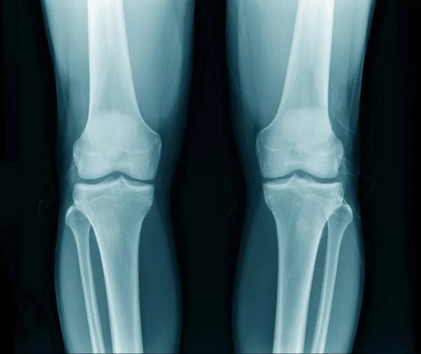 Рентгенівське Зображення Колінного Суглоба Перегляд — стокове фото
