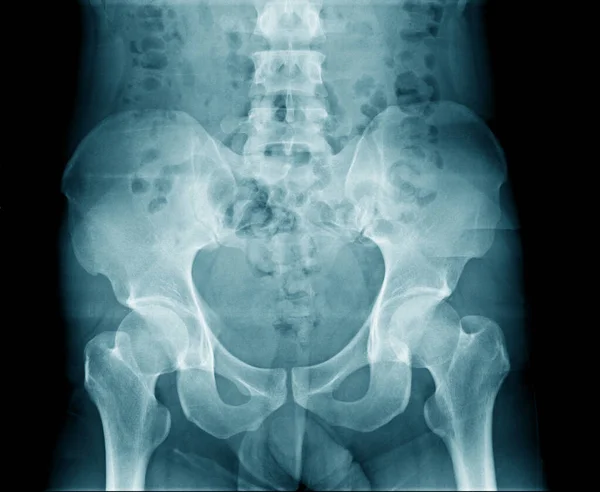 x-ray image pelvic bone and hip joint and lumbosacral joint
