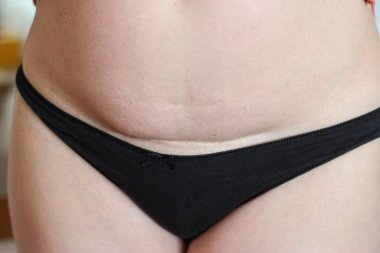 Ameliyattan Yıllar Sonra Sezaryen Yara izi