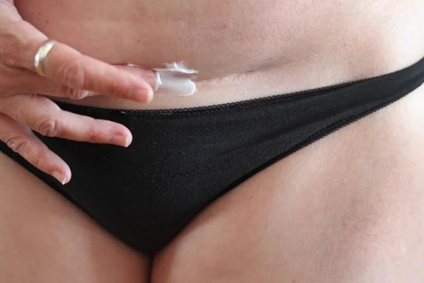 Frau mit Kaiserschnitt-Narbe cremt die Narbe ein — Stockfoto