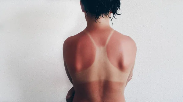 Kulit gadis terbakar di bawah sinar matahari — Stok Foto