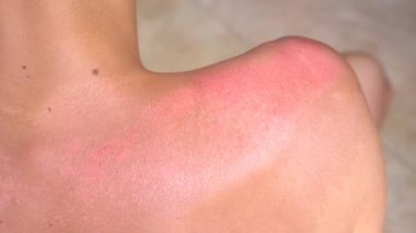 Şiddetli güneş yanığı belirtileri: kızarıklık, ağrı, cilt soyma, cilt yanma ve kabarma