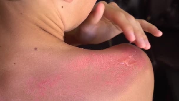 Een Jonge Man Met Ernstige Zonnebrand Sunburn Behandeling Speciale Burn — Stockvideo